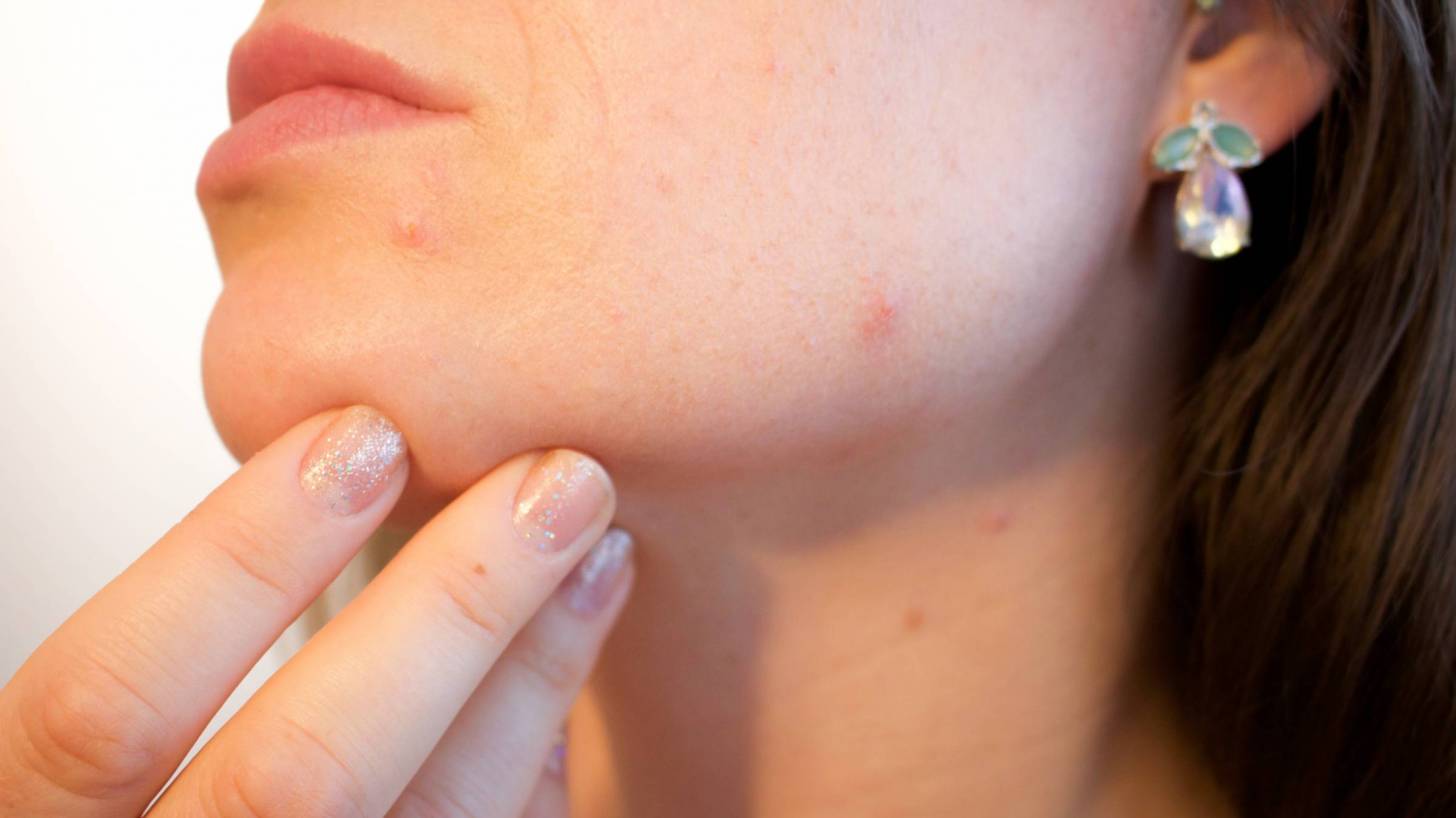 woman looking at her acne on her chin