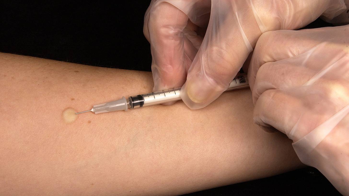 TB skin test on arm