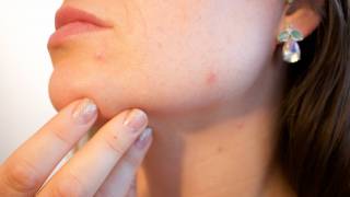 woman looking at her acne on her chin