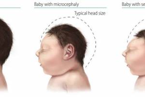 Zika and Microcephaly