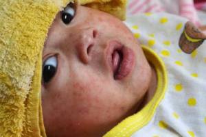 CDC measles cases in children