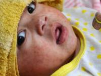 CDC measles cases in children